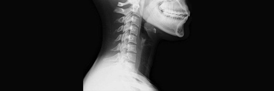 X-ray of a whiplash injury.