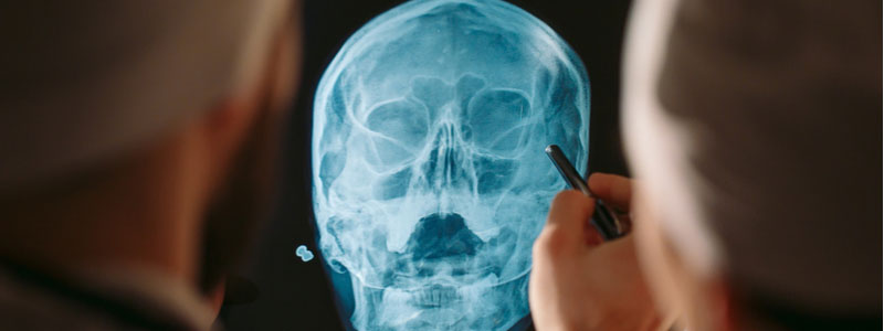 A photo of a doctor evaluating x-rays for any signs of a head injury. Head injury. Brain injury. Concussion. Concussion symptoms. Head trauma. Head injury symptoms. Signs and symptoms of a concussion. Bump on the head. What are the symptoms of a concussion. What are the symptoms of a headache that won’t go away. How can I detect a head injury. What should I do if I have a concussion/ head injury. How can you get a brain injury. What are some brain injury symptoms. Should I talk to a lawyer about my head injury. Should I visit a doctor after hitting my head. What are the signs of a head injury. What are the signs and symptoms of a concussion. What are the types of concussions. Do I have a concussion. Head injury assessment. Mild concussion symptoms. How To Detect A Traumatic Head Injury 